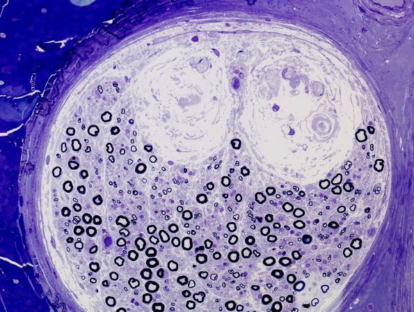 12F Renaut bodies (Case 17) Plastic 3