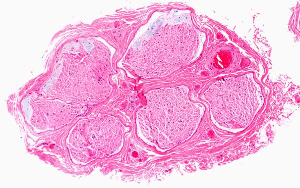 12G1 Renaut Anti-MAG (Case 18) B1 H&E 10Xa
