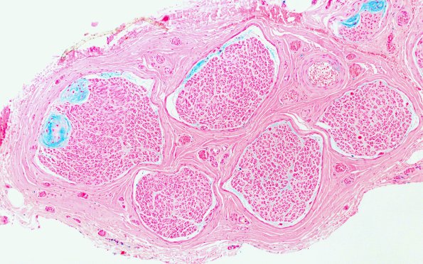 12G2 Renaut Anti-MAG (Case 18) B1 Alcian Blue 10X 1