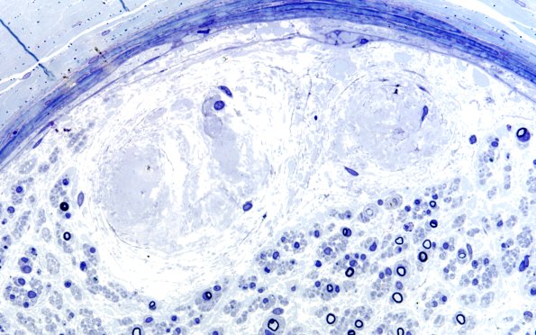 12I2 Renaut bodies (Case 12I) 60X 2