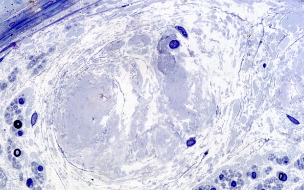 12I3 Renaut bodies (Case 12I) 100X 4