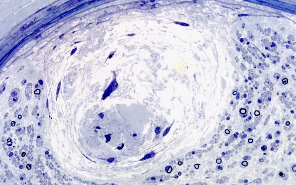 12I4 Renaut bodies (Case 12I) 60X 1