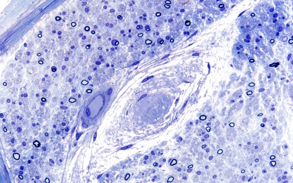 12I5 Renaut bodies (Case 12I) 60X 3