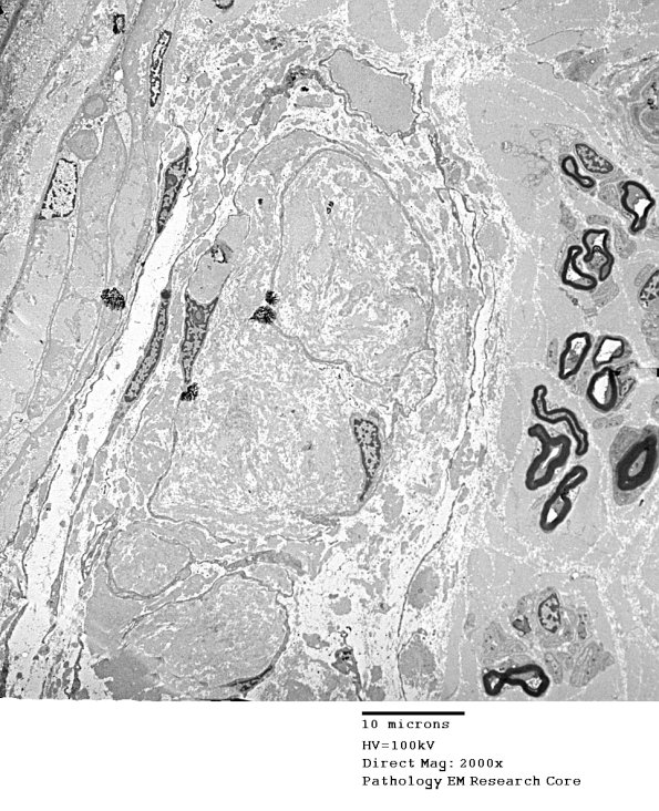 1B1 Renaut bodies (Case 1) EM 007A - Copy