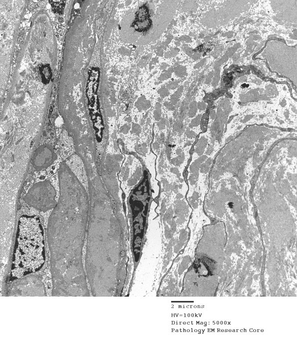 1B10 Renaut bodies (Case 1) EM 010A - Copy
