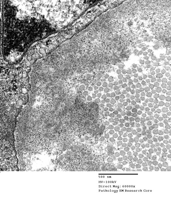 1B12 Renaut bodies (Case 1) EM 042A - Copy
