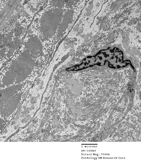1B13 Renaut bodies (Case 1) EM 049a - Copy