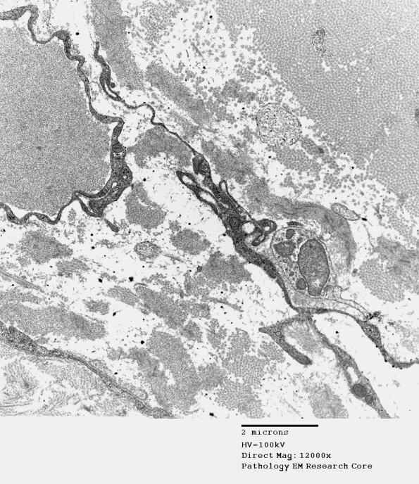 1B14 Renaut bodies (Case 1) EM 012A (2) - Copy