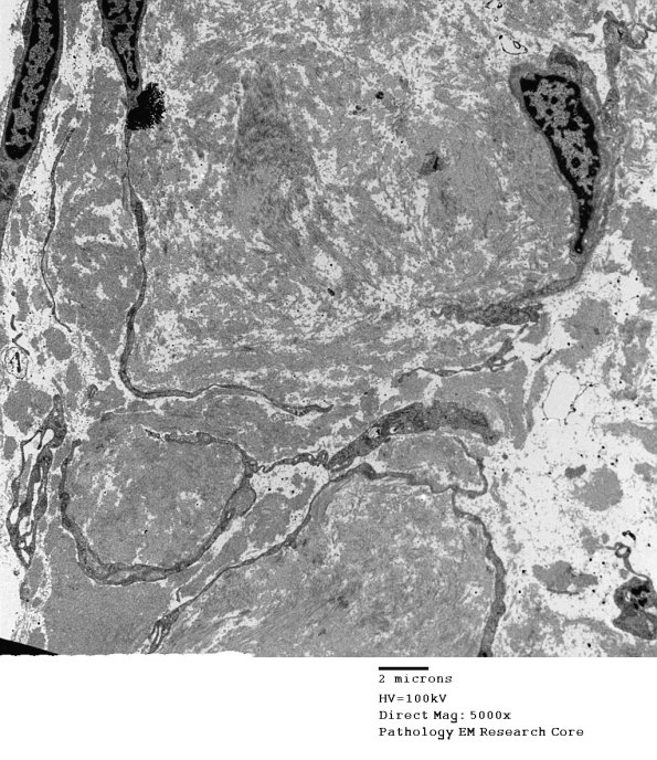 1B2 Renaut bodies (Case 1) EM 008A - Copy