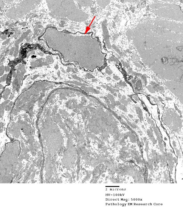 1B3 Renaut bodies (Case 1) EM 009A copy.jpg