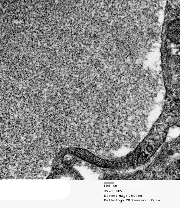 1B4 Renaut bodies (Case 1) EM 017A - Copy