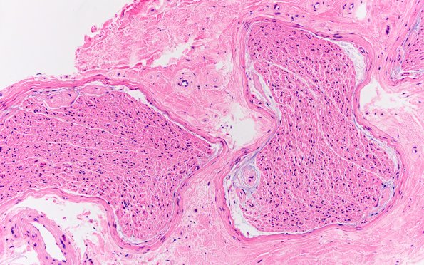 2A1 Renaut bodies, (⁮Case 2) H&E 20X 8A