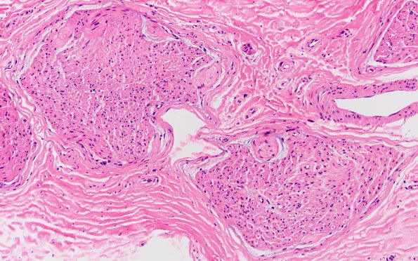 2A2 Renaut bodies, (⁮Case 2) 20X 4A