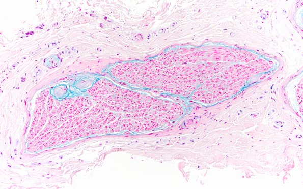 2B1 Renaut bodies, (⁮Case 2) Alcian blue 20X 1a