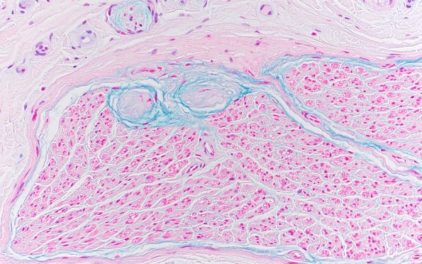 2B2 Renaut bodies, (⁮Case 2) Alcian blue 20X 2A