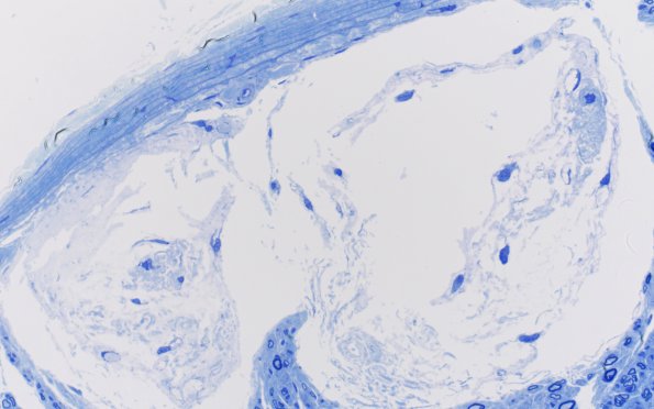 2C2 Renaut bodies, (⁮Case 2) 40X 1A