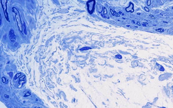 2C3 Renaut bodies, (⁮Case 2) 100X 4A