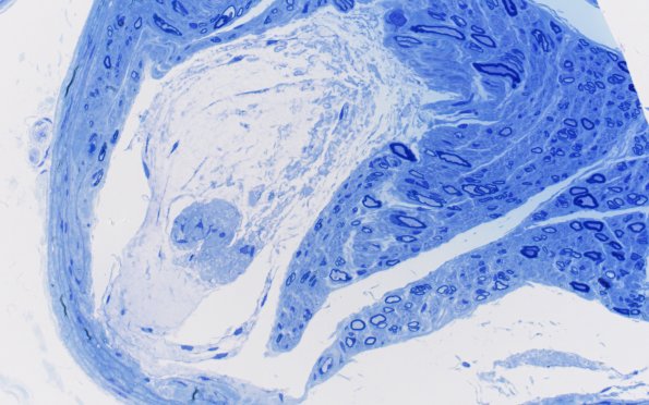 2C4 Renaut bodies, (⁮Case 2) 40X 4A