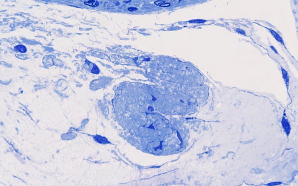 2C5 Renaut bodies, (⁮Case 2) 100X 3A