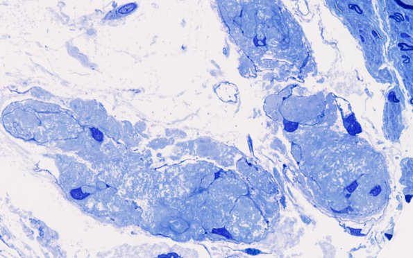 2C6 Renaut bodies, (⁮Case 2) 100X 6A