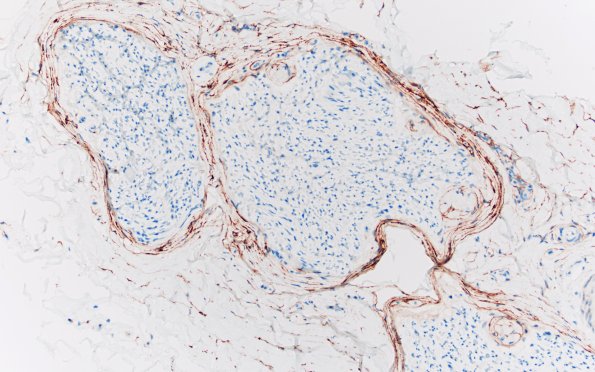 2D1 Renaut bodies, (⁮Case 2) EMA 20X 1A