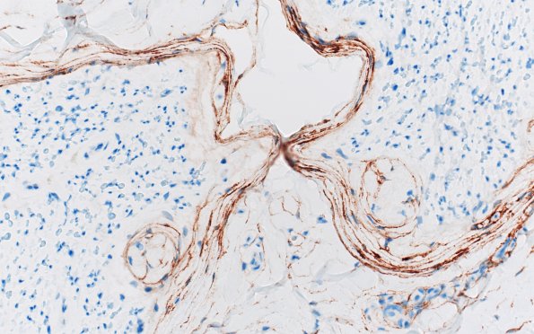 2D2 Renaut bodies, (⁮Case 2) EMA 40X 1A