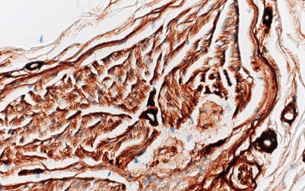 2E3 Renaut bodies, (⁮Case 2) Coll IV 40X 4A