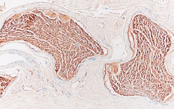 2F1 Renaut bodies, (⁮Case 2) S100 20X 1A