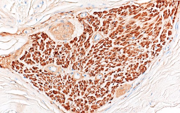 2F2 Renaut bodies, (⁮Case 2) S100 40X 3A