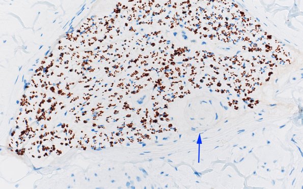 2G1 Renaut bodies, (⁮Case 2) NF 40X 1 copyA