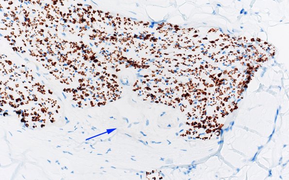 2G2 Renaut bodies, (⁮Case 2) NF 40X 3 copyA