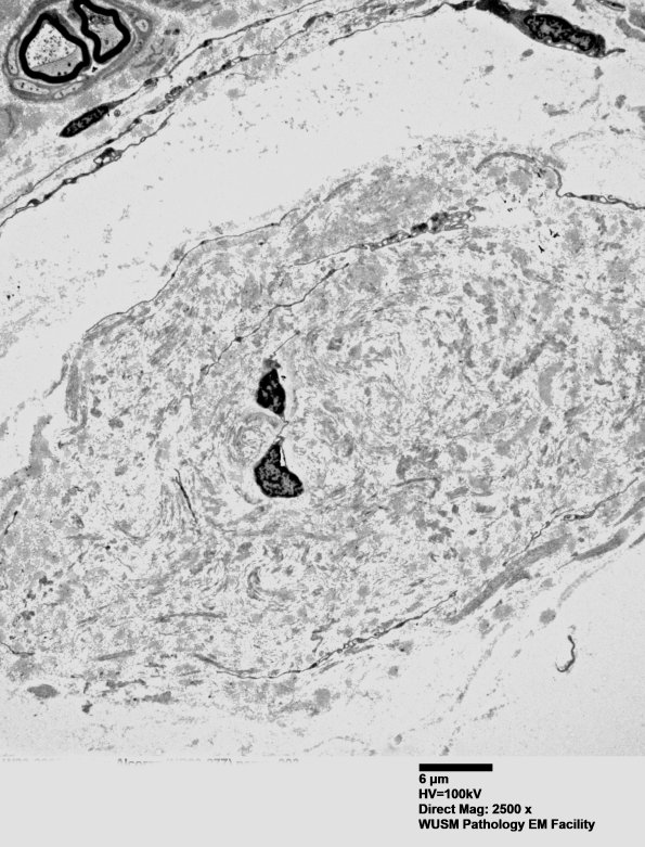 2H1 (⁮Case 2) nerve_003 - CopyA