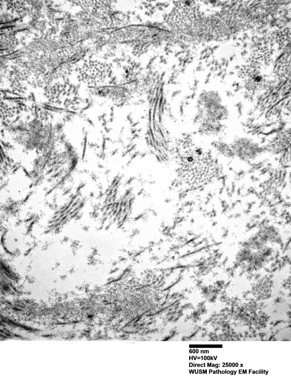 2H4 (⁮Case 2) nerve_023 - CopyA