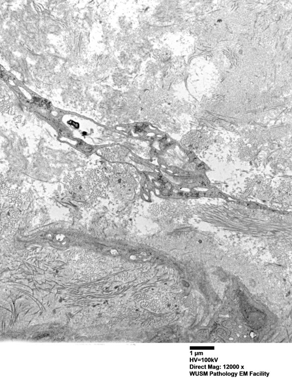 2H9 (⁮Case 2) nerve_042 - CopyA