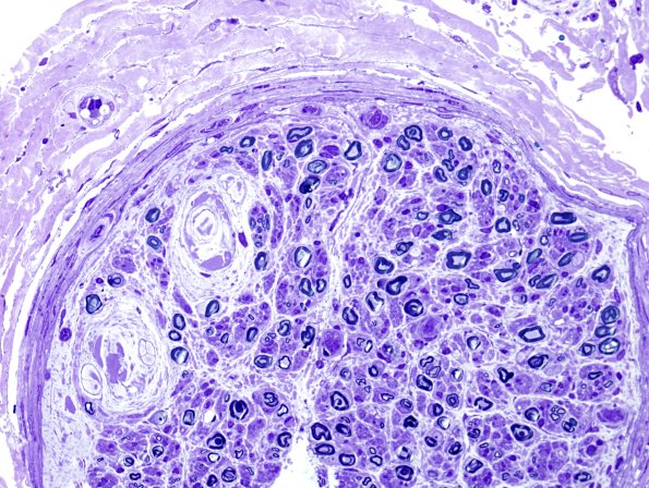 3A1 Renaut Bodies CIDP (⁮Case 3) Plastic 1A