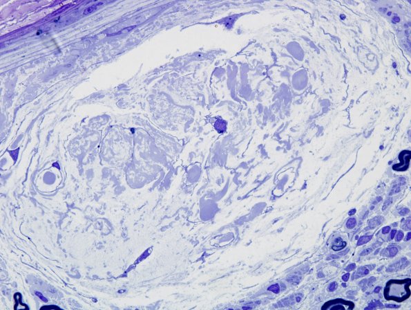 3A3 Renaut Bodies CIDP (Case 3) Plastic 3