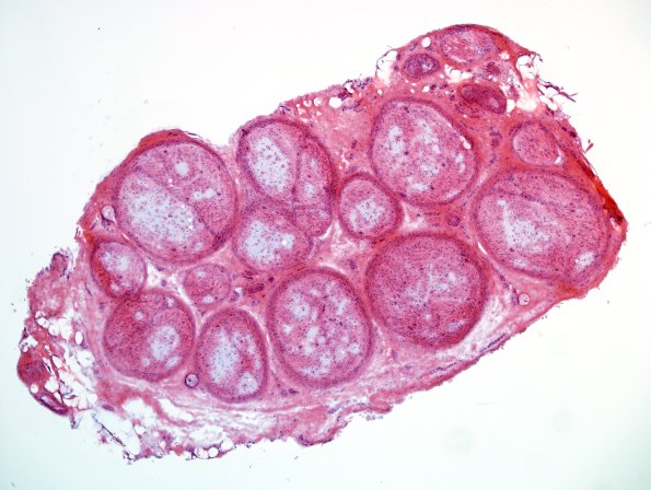 5A1 Renaut body-oma (Case 5) H&E 4X.jpg