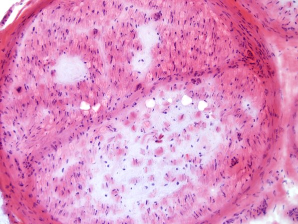 5A2 Renaut body-oma (Case 5) H&E 3.jpg