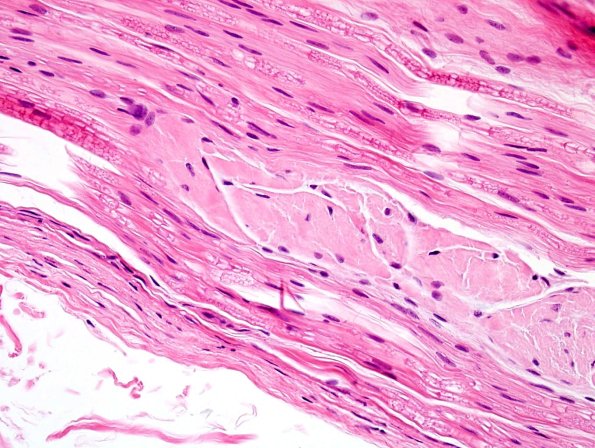 5A3 Renaut body-oma (Case 5) H&E 4