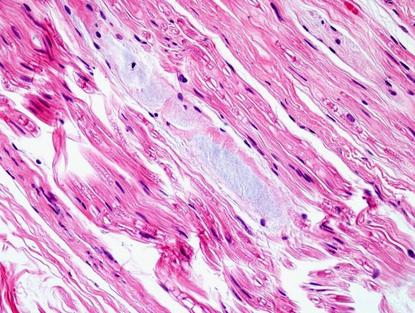 5A4 Renaut body-oma (Case 5) H&E 6