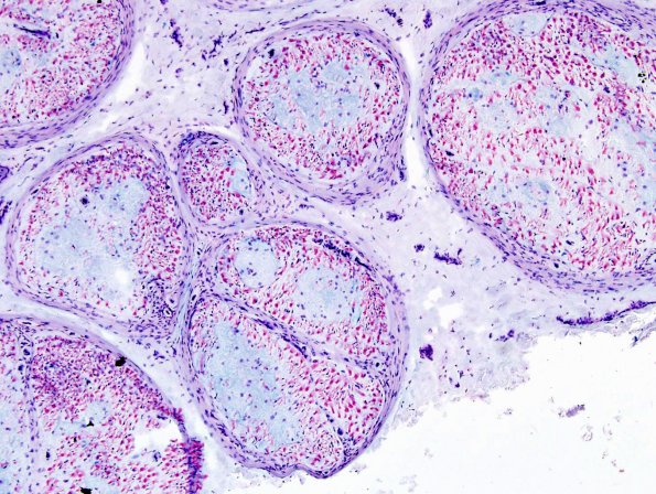 5B2 Renaut body-oma (Case 5) Alcian Blue 10X 3