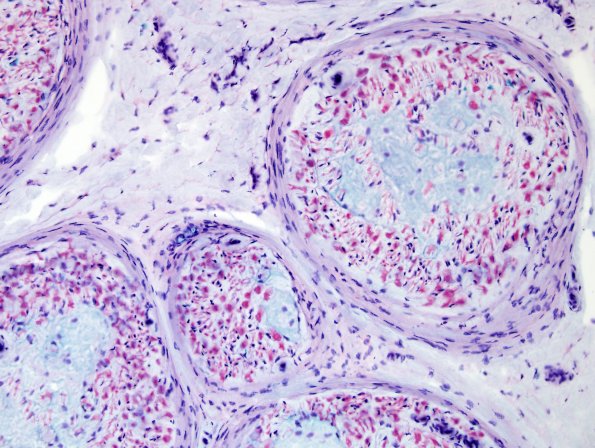 5B4 Renaut body-oma (Case 5) Alcian Blue 3.jpg