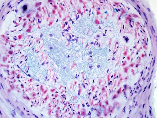 5B5 Renaut body-oma (Case 5) Alcian Blue 2.jpg