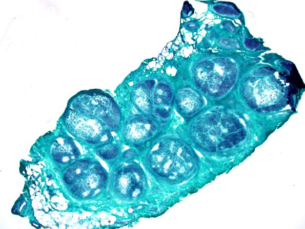 5D Renaut body-oma (Case 5) Gomori Trichrome.jpg