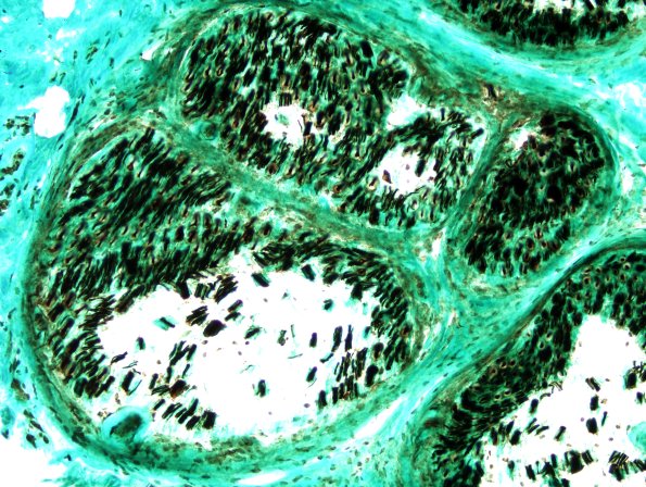 5E Renaut body-oma (Case 5) NF 1.jpg