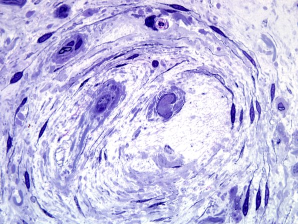 5F10 Renaut body-oma (Case 5) Plastic 100X 26.jpg