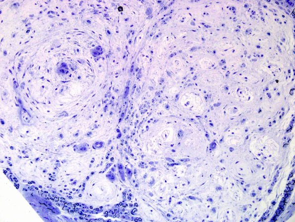 5F4 Renaut body-oma (Case 5) Plastic 2