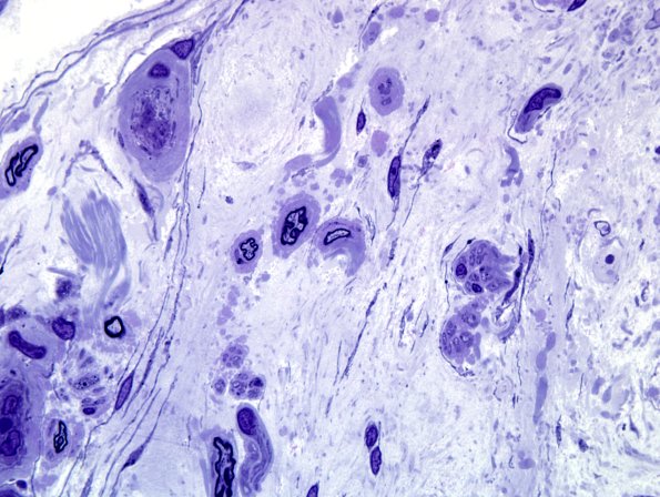 5F6 Renaut body-oma (Case 5) Plastic 100X 6.jpg