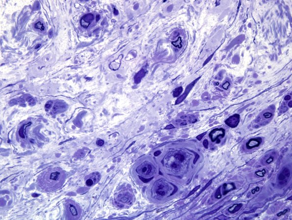 5F7 Renaut body-oma (Case 5) Plastic 100X 22.jpg