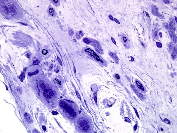 5F9 Renaut body-oma (Case 5) Plastic 100X 25.jpg